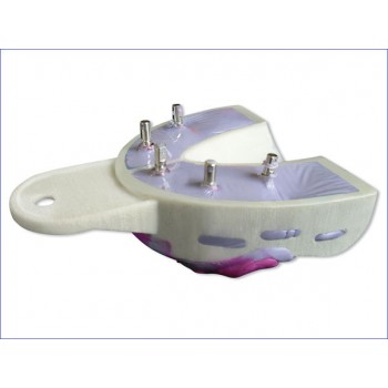 Miratray Implant Upper S1, 6 pcs.