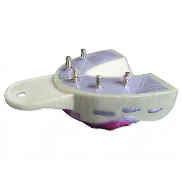 Miratray Implant Upper S1, 6 pcs.