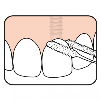 Fio Dentário Pontes & Implantes - TePe