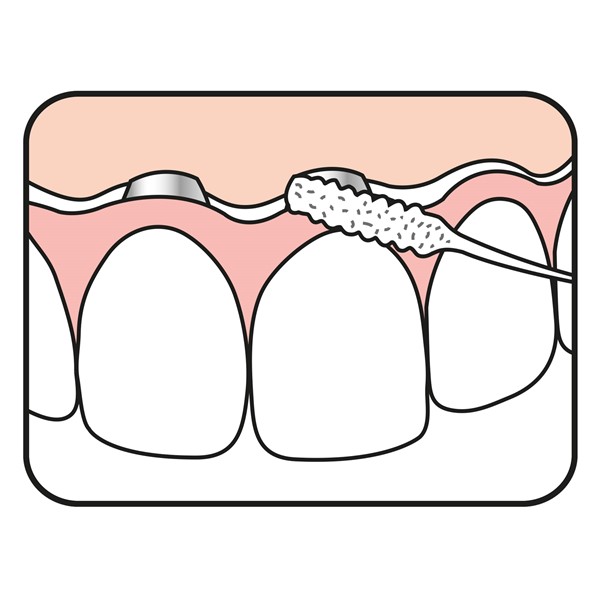 Fio dentário Pontes & Implantes TePe Fio dentário Pontes & Implantes TePe